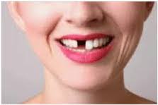 Mimpi Gigi Ompong Bagian Depan Atas